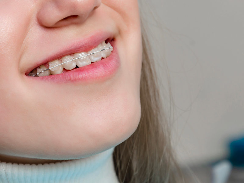 Orthodontie à Taverny