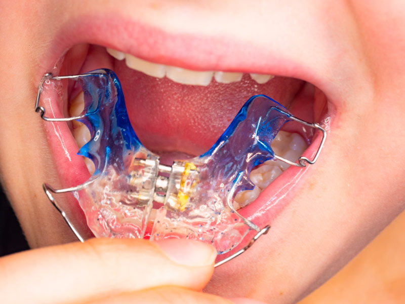 Orthodontie à Taverny